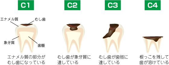 むし歯の進行